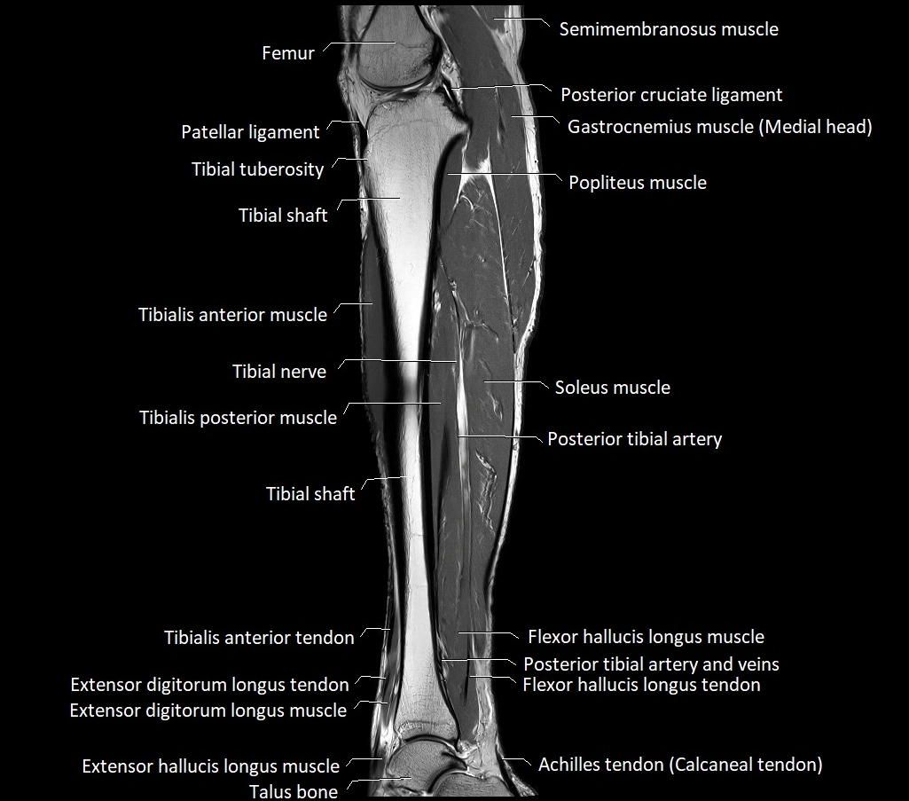 Lower leg sagittal anatomy 3T MRI image 18.webp